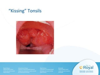 “Kissing” Tonsils
 