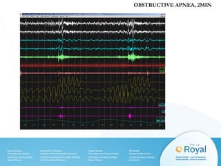 OBSTRUCTIVE APNEA, 2MIN
 