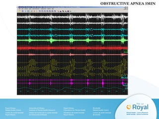 OBSTRUCTIVE APNEA 5MIN
 