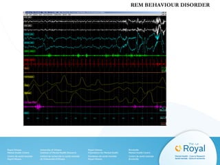 REM BEHAVIOUR DISORDER
 
