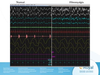 Normal Fibromyalgia
 