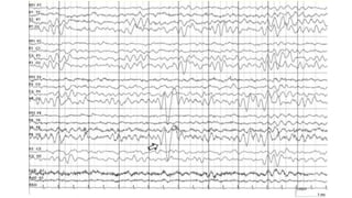 SLEEP EEG and findings, stages of sleep. | PPTX
