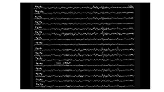 SLEEP EEG and findings, stages of sleep. | PPTX