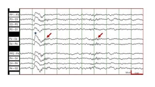 SLEEP EEG and findings, stages of sleep. | PPTX