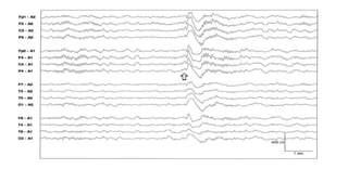 SLEEP EEG and findings, stages of sleep. | PPTX