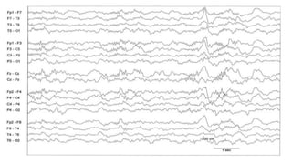 SLEEP EEG and findings, stages of sleep. | PPTX