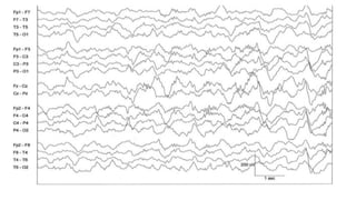 SLEEP EEG and findings, stages of sleep. | PPTX