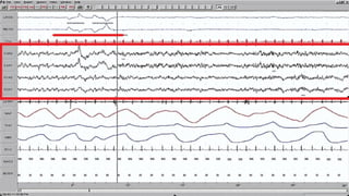 SLEEP EEG and findings, stages of sleep. | PPTX