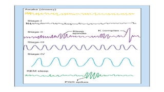 SLEEP EEG and findings, stages of sleep. | PPTX