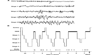 SLEEP EEG and findings, stages of sleep. | PPTX