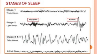 Sleep spindles K-complex
STAGES OF SLEEP
 