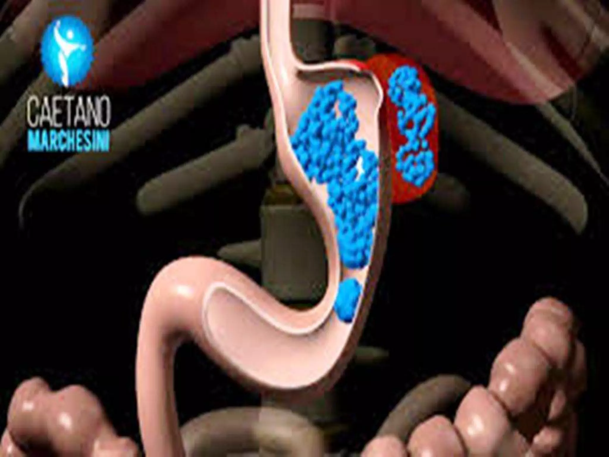 Sleeve gastrectomy education PPT