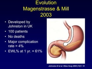 Sleeve gastrectomy in patients with bmi | PPTX