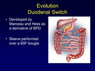 Sleeve gastrectomy in patients with bmi | PPTX