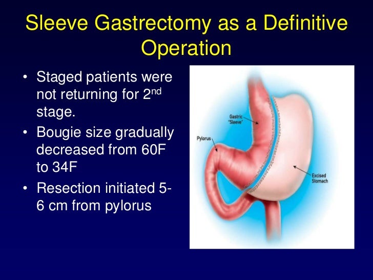 Sleeve gastrectomy in patients with bmi