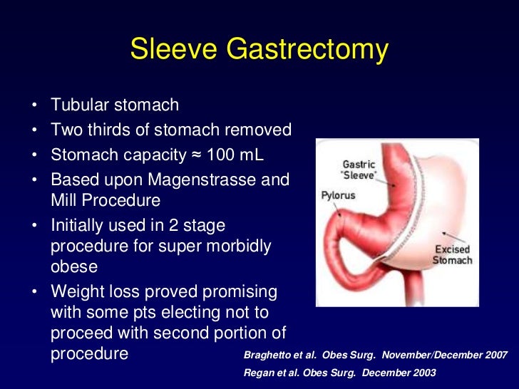 Sleeve gastrectomy in patients with bmi