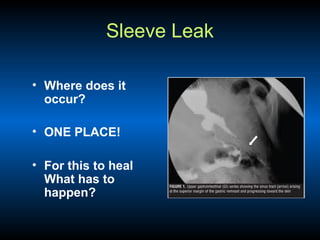 Sleeve Leak
• Where does it
occur?
• ONE PLACE!
• For this to heal
What has to
happen?

 