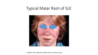 Systemic lupus erythematous (SLE) Lecture | PPTX