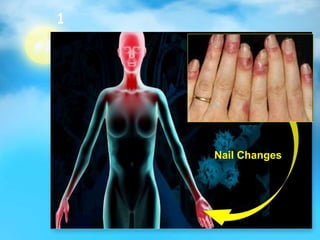 1
Nail Changes
 