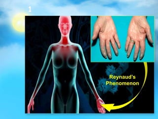 1
Reynaud’s
Phenomenon
 