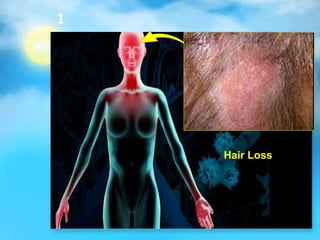 1
Hair Loss
 