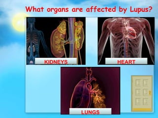 What organs are affected by Lupus?
LUNGS
KIDNEYS HEART
 