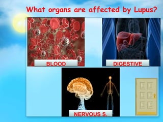 What organs are affected by Lupus?
DIGESTIVEBLOOD
NERVOUS S.
 
