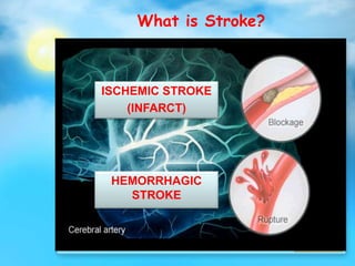 What is Stroke?
ISCHEMIC STROKE
(INFARCT)
HEMORRHAGIC
STROKE
 