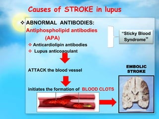 Causes of STROKE in lupus
 ABNORMAL ANTIBODIES:
Antiphospholipid antibodies
(APA)
 Anticardiolipin antibodies
 Lupus anticoagulant
ATTACK the blood vessel
initiates the formation of BLOOD CLOTS
EMBOLIC
STROKE
“Sticky Blood
Syndrome”
 