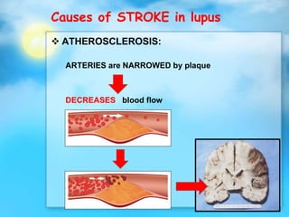 Causes of STROKE in lupus
 ATHEROSCLEROSIS:
ARTERIES are NARROWED by plaque
DECREASES blood flow
 