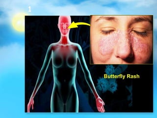 1
Butterfly Rash
 