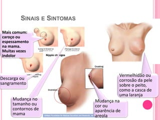 SINAIS E SINTOMAS
110
Mais comum:
caroço ou
espessamento
na mama.
Muitas vezes
indolor
Mudança na
cor ou
aparência de
areola
Vermelhidão ou
corrosão da pele
sobre o peito,
como a casca de
uma laranja
Descarga ou
sangramento
Mudança no
tamanho ou
contornos de
mama
 