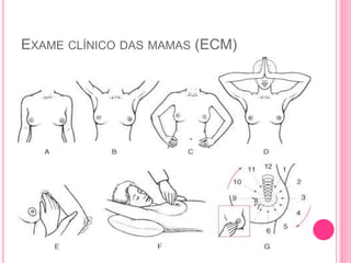 EXAME CLÍNICO DAS MAMAS (ECM)
 