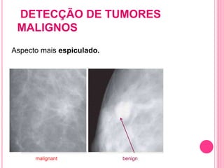 DETECÇÃO DE TUMORES
MALIGNOS
Aspecto mais espiculado.
125malignant benign
 
