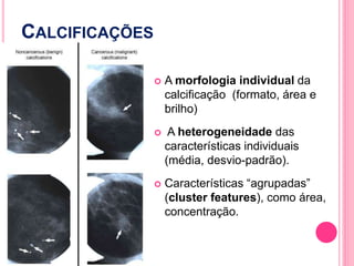 CALCIFICAÇÕES
 A morfologia individual da
calcificação (formato, área e
brilho)
 A heterogeneidade das
características individuais
(média, desvio-padrão).
 Características “agrupadas”
(cluster features), como área,
concentração.
128
 
