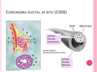 CARCINOMA DUCTAL IN SITU (CDIS)
27
Illustration © Mary K. Bryson
Células
Ductais
Cancerosas
Células
Ductais
Normais
 