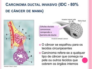CARCINOMA DUCTAL INVASIVO (IDC - 80%
DE CÂNCER DE MAMA)
 O câncer se espalhou para os
tecidos circunjacentes
 Carcinoma refere-se a qualquer
tipo de câncer que começa na
pele ou outros tecidos que
cobrem os órgãos internos
28Illustration © Mary K. Bryson
Células ductais
cancerosas
rompendo a
barreira do ducto
 