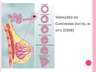 VARIAÇÕES DO
CARCINOMA DUCTAL IN
SITU (CDIS)
29
 