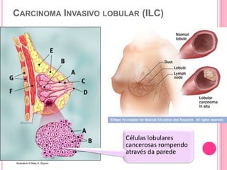 CARCINOMA INVASIVO LOBULAR (ILC)
30Illustration © Mary K. Bryson
Células lobulares
cancerosas rompendo
através da parede
 