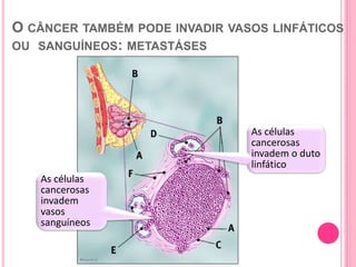 O CÂNCER TAMBÉM PODE INVADIR VASOS LINFÁTICOS
OU SANGUÍNEOS: METASTÁSES
31Illustration © Mary K. Bryson
As células
cancerosas
invadem o duto
linfático
As células
cancerosas
invadem
vasos
sanguíneos
 