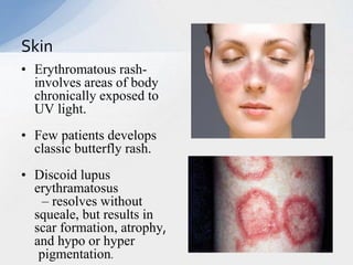 • Erythromatous rash-
involves areas of body
chronically exposed to
UV light.
• Few patients develops
classic butterfly rash.
• Discoid lupus
erythramatosus
– resolves without
squeale, but results in
scar formation, atrophy,
and hypo or hyper
pigmentation.
Skin
 