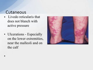 • Livedo reticularis that
does not blanch with
active pressure
• Ulcerations - Especially
on the lower extremities,
near the malleoli and on
the calf
•
Cutaneous
 