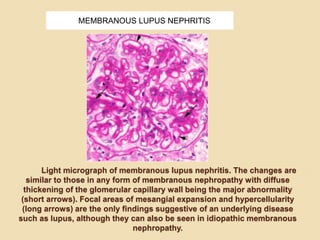 Light micrograph of membranous lupus nephritis. The changes are
similar to those in any form of membranous nephropathy with diffuse
thickening of the glomerular capillary wall being the major abnormality
(short arrows). Focal areas of mesangial expansion and hypercellularity
(long arrows) are the only findings suggestive of an underlying disease
such as lupus, although they can also be seen in idiopathic membranous
nephropathy.
MEMBRANOUS LUPUS NEPHRITIS
 