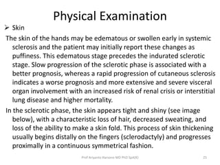 Physical Examination 
 Skin 
The skin of the hands may be edematous or swollen early in systemic 
sclerosis and the patient may initially report these changes as 
puffiness. This edematous stage precedes the indurated sclerotic 
stage. Slow progression of the sclerotic phase is associated with a 
better prognosis, whereas a rapid progression of cutaneous sclerosis 
indicates a worse prognosis and more extensive and severe visceral 
organ involvement with an increased risk of renal crisis or interstitial 
lung disease and higher mortality. 
In the sclerotic phase, the skin appears tight and shiny (see image 
below), with a characteristic loss of hair, decreased sweating, and 
loss of the ability to make a skin fold. This process of skin thickening 
usually begins distally on the fingers (sclerodactyly) and progresses 
proximally in a continuous symmetrical fashion. 
Prof Ariyanto Harsono MD PhD SpA(K) 25 
 