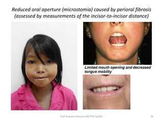 Reduced oral aperture (microstomia) caused by perioral fibrosis 
(assessed by measurements of the incisor-to-incisor distance) 
Prof Ariyanto Harsono MD PhD SpA(K) 26 
 