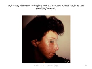 Tightening of the skin in the face, with a characteristic beaklike facies and 
paucity of wrinkles. 
Prof Ariyanto Harsono MD PhD SpA(K) 27 
 