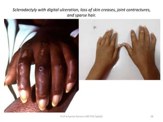 Sclerodactyly with digital ulceration, loss of skin creases, joint contractures, 
and sparse hair. 
Prof Ariyanto Harsono MD PhD SpA(K) 28 
 