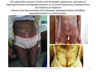 Skin pigmentary changes include a salt-and-pepper appearance, with areas of 
hyperpigmentation and hypopigmentation, or an overall appearance of darkened skin 
not related to sun exposure 
Anterior chest demonstrating salt-and-pepper hypopigmentation and diffuse 
hyperpigmentation in a white woman. 
Prof Ariyanto Harsono MD PhD SpA(K) 29 
 