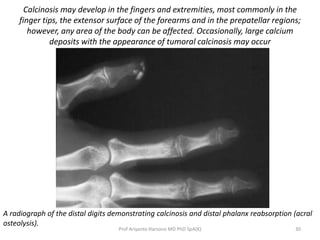 Calcinosis may develop in the fingers and extremities, most commonly in the 
finger tips, the extensor surface of the forearms and in the prepatellar regions; 
however, any area of the body can be affected. Occasionally, large calcium 
deposits with the appearance of tumoral calcinosis may occur 
A radiograph of the distal digits demonstrating calcinosis and distal phalanx reabsorption (acral 
osteolysis). 
Prof Ariyanto Harsono MD PhD SpA(K) 30 
 