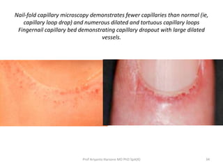 Nail-fold capillary microscopy demonstrates fewer capillaries than normal (ie, 
capillary loop drop) and numerous dilated and tortuous capillary loops 
Fingernail capillary bed demonstrating capillary dropout with large dilated 
vessels. 
Prof Ariyanto Harsono MD PhD SpA(K) 34 
 
